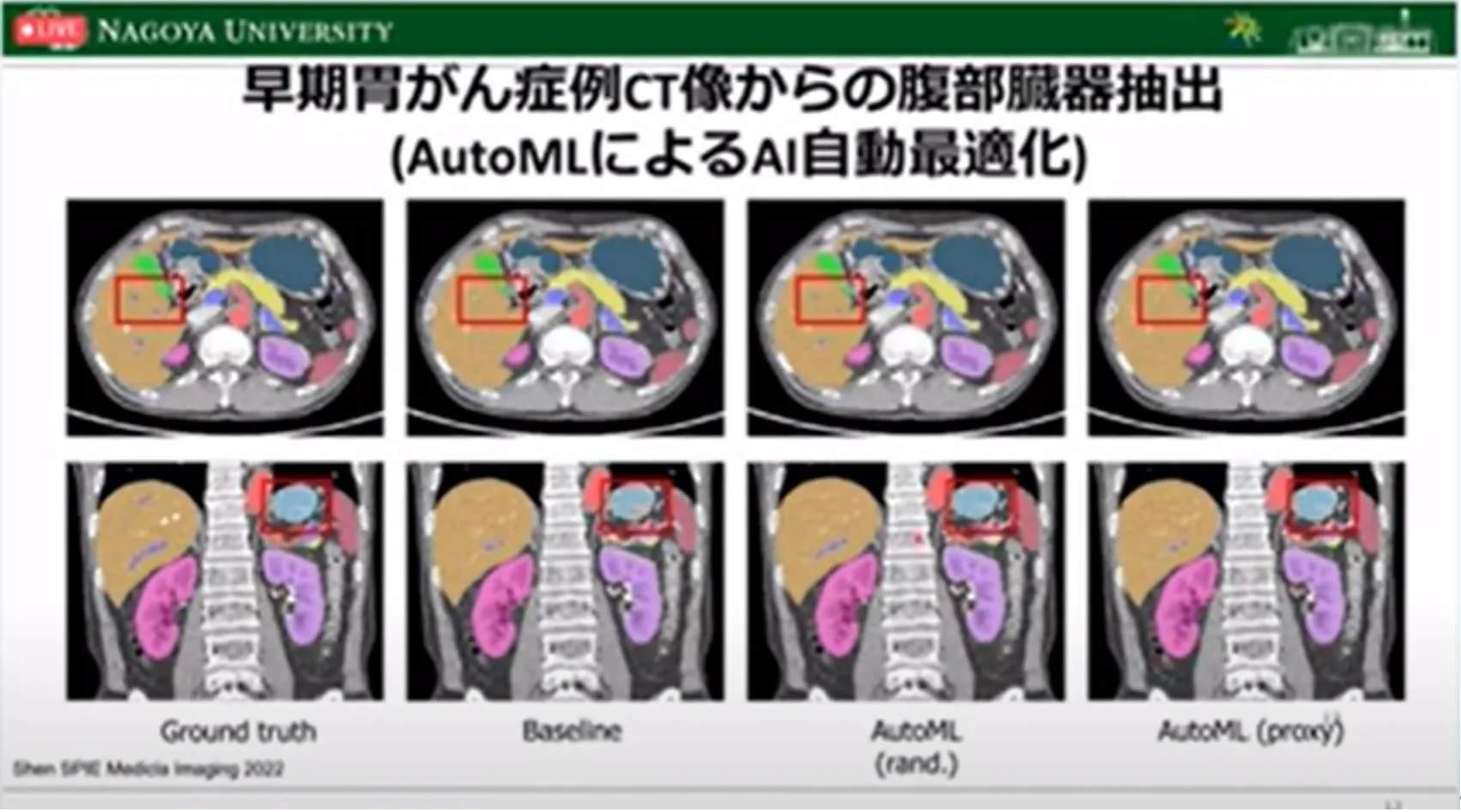 胃がん診断・治療のすべての段階でAI利活用の可能性を探る!名古屋大学大学院・森健策教授による最新研究の紹介(第94回日本胃癌学会総会)