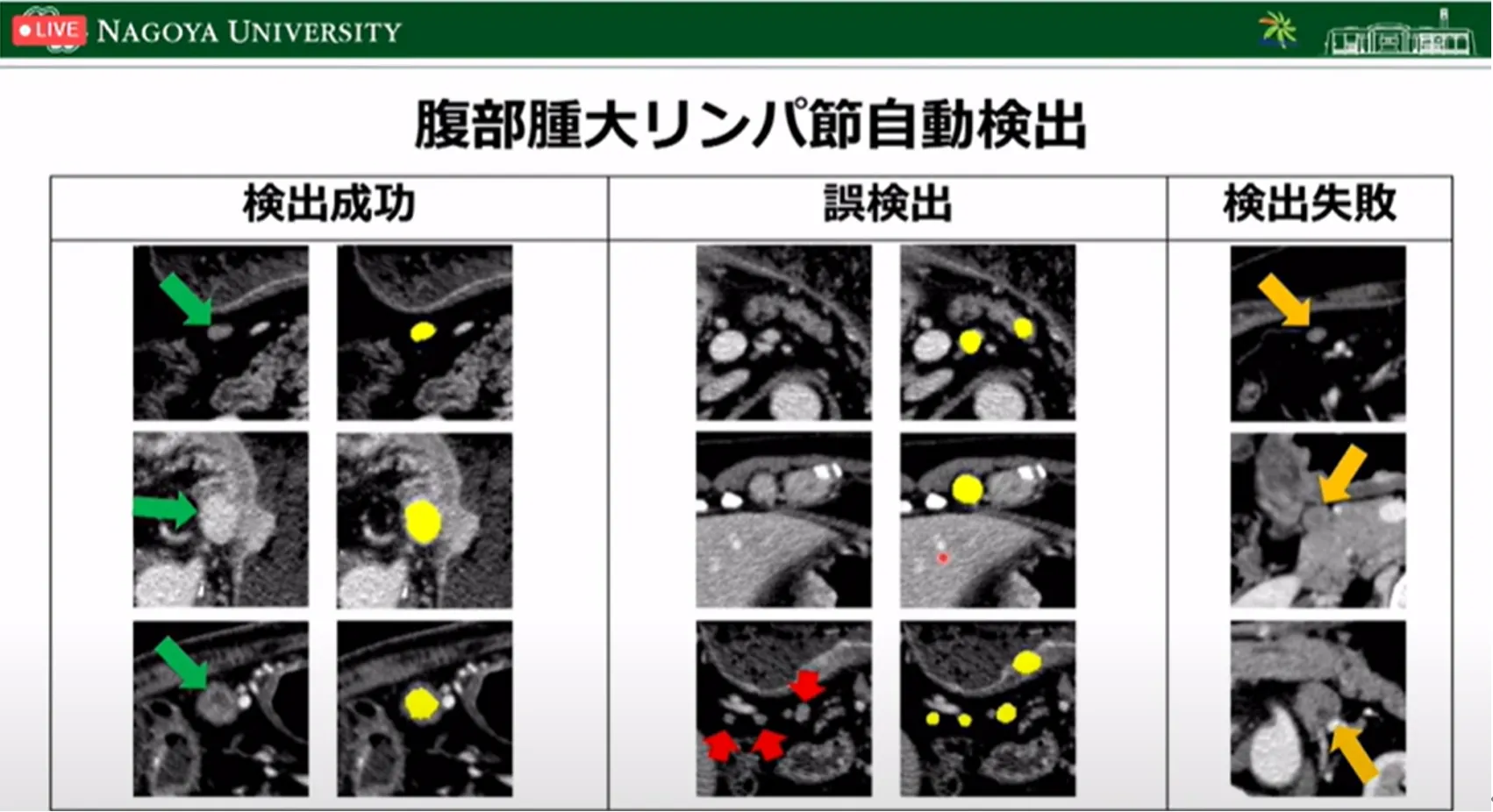 胃がん診断・治療のすべての段階でAI利活用の可能性を探る!名古屋大学大学院・森健策教授による最新研究の紹介(第94回日本胃癌学会総会)