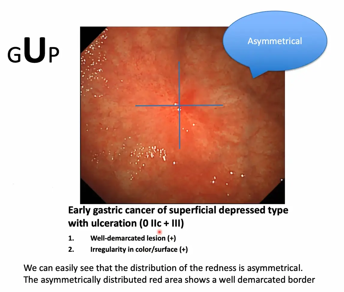 （図3）e-Learning Systemにおける早期胃がんのシンプルな診断基準