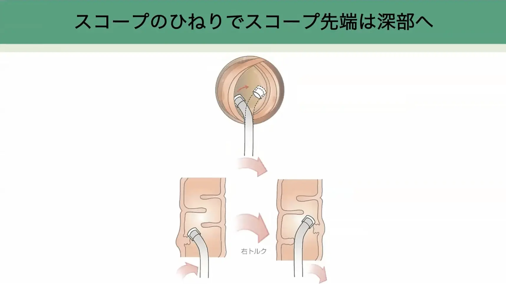 大腸内視鏡の挿入法、動画でわかる“無痛”のコツ - ガストロAI media